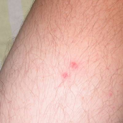 Острая крапивница – аллергическая реакция на коже